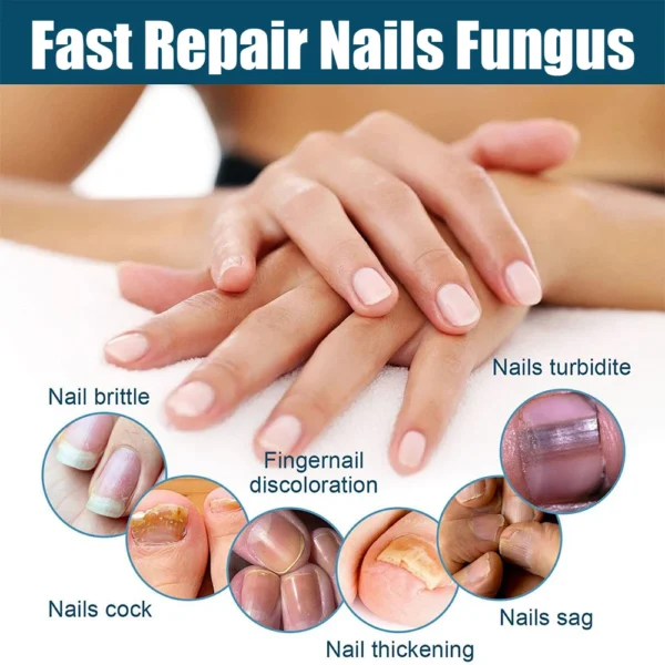 Electric Fungal Nail Laser Device Repair Fast Nails Fungus Onychomycosis Repair Toenail Fingernail Removes Nail Fungus Foot Care - Image 4